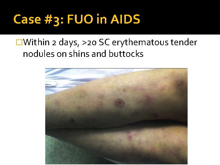 Case #3: FUO in AIDS �Within 2 days, >20 SC erythematous tender nodules on