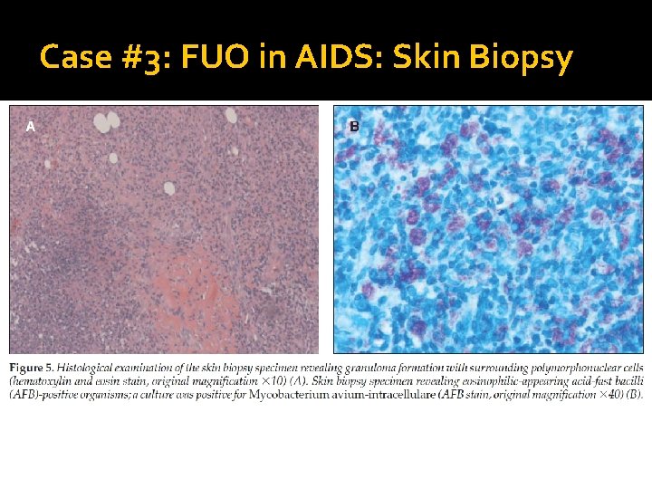 Case #3: FUO in AIDS: Skin Biopsy 