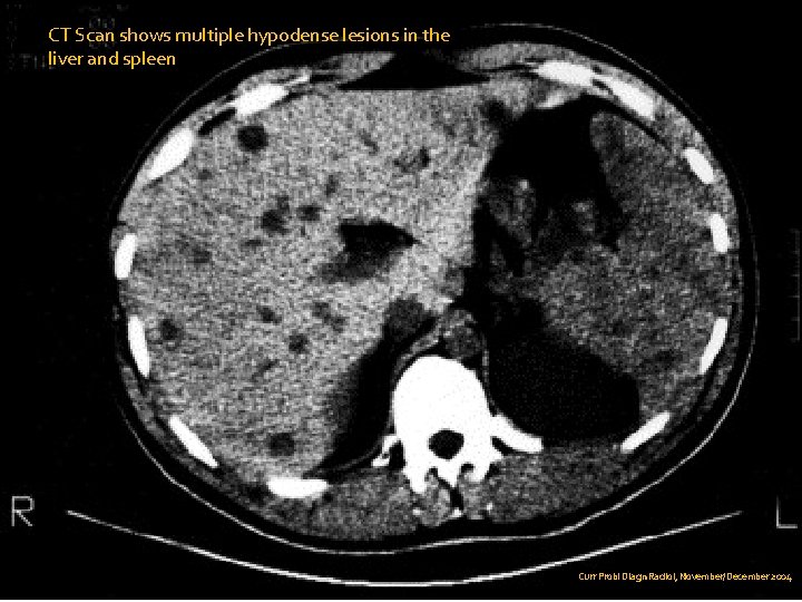 CT Scan shows multiple hypodense lesions in the liver and spleen. Curr Probl Diagn
