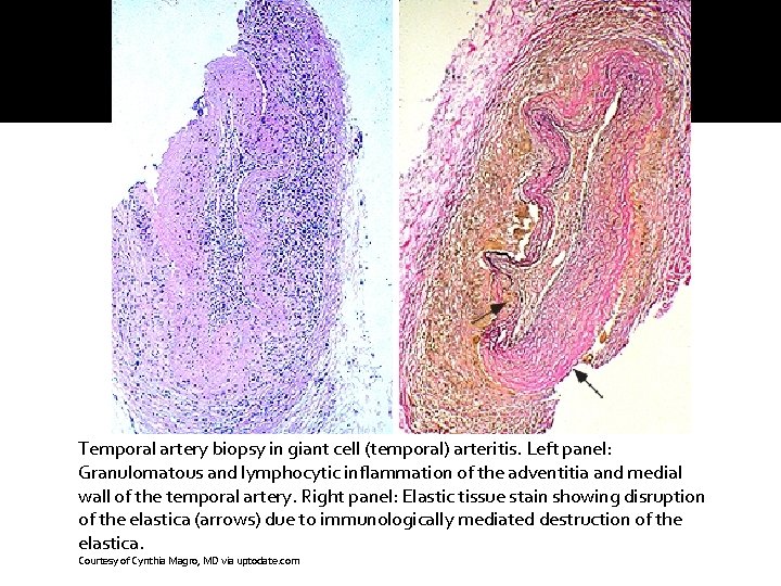 Temporal artery biopsy in giant cell (temporal) arteritis. Left panel: Granulomatous and lymphocytic inflammation