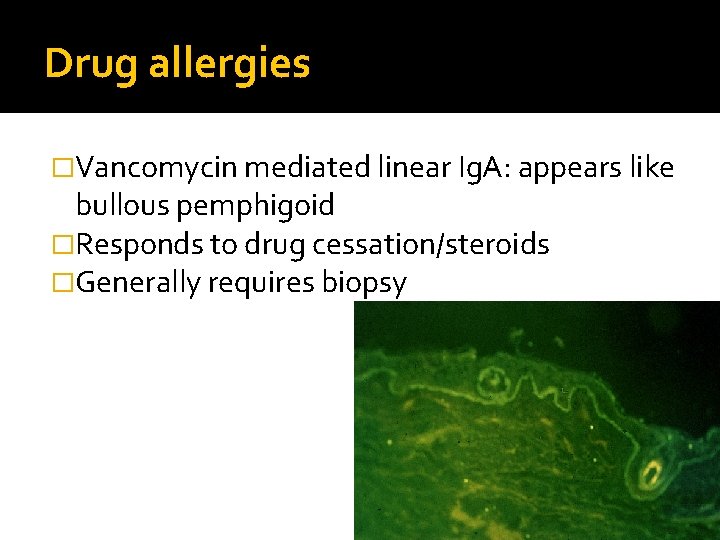 Drug allergies �Vancomycin mediated linear Ig. A: appears like bullous pemphigoid �Responds to drug
