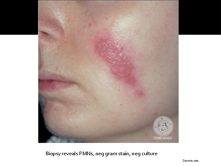 Biopsy reveals PMNs, neg gram stain, neg culture Dermis. net 