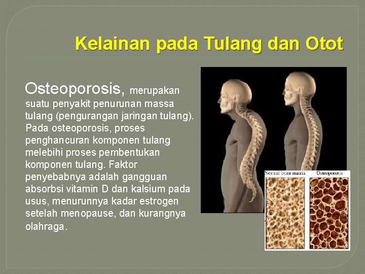 Kelainan pada Tulang dan Otot Osteoporosis, merupakan suatu penyakit penurunan massa tulang (pengurangan jaringan