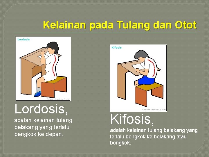 Kelainan pada Tulang dan Otot Lordosis, adalah kelainan tulang belakang yang terlalu bengkok ke