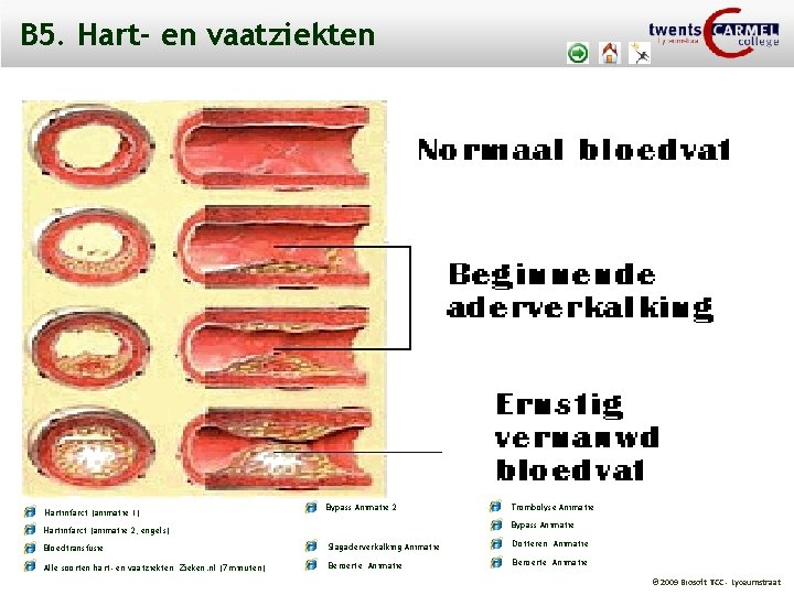 B 5. Hart- en vaatziekten Hartinfarct (animatie 1) Bypass Animatie 2 Trombolyse Animatie Bypass