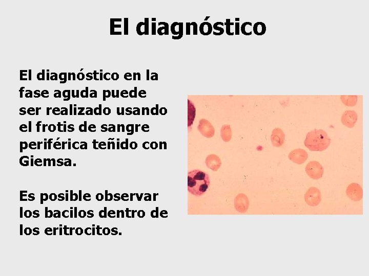 El diagnóstico en la fase aguda puede ser realizado usando el frotis de sangre