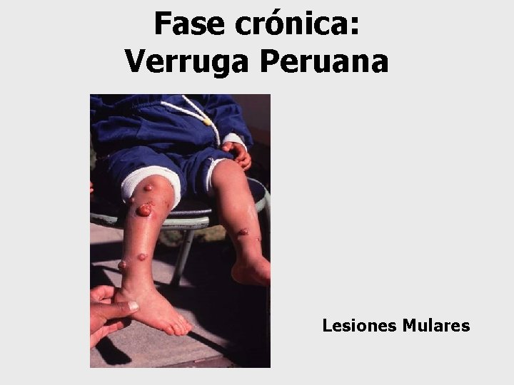 Fase crónica: Verruga Peruana Lesiones Mulares 