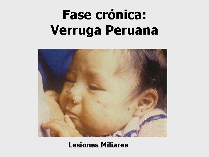 Fase crónica: Verruga Peruana Lesiones Miliares 