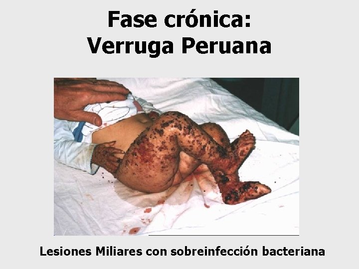 Fase crónica: Verruga Peruana Lesiones Miliares con sobreinfección bacteriana 