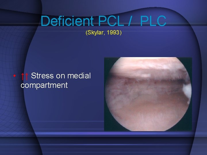 Deficient PCL / PLC (Skylar, 1993) • ↑↑ Stress on medial compartment 