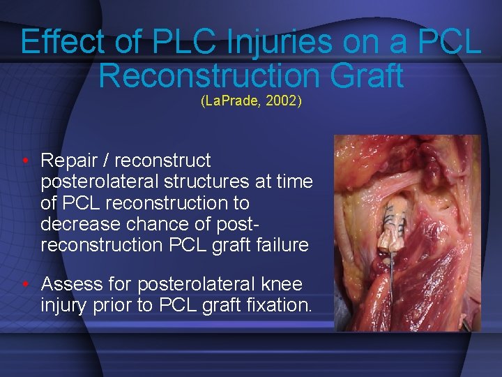 Effect of PLC Injuries on a PCL Reconstruction Graft (La. Prade, 2002) • Repair