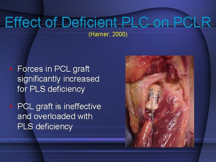 Effect of Deficient PLC on PCLR (Harner, 2000) • Forces in PCL graft significantly