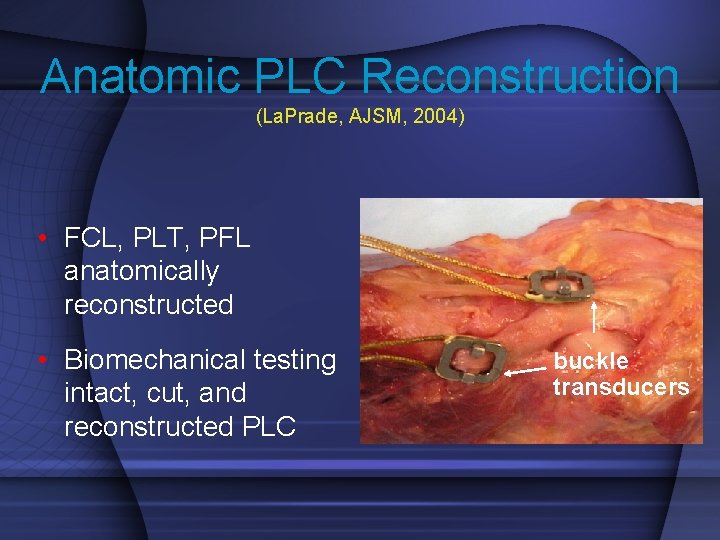 Anatomic PLC Reconstruction (La. Prade, AJSM, 2004) • FCL, PLT, PFL anatomically reconstructed •