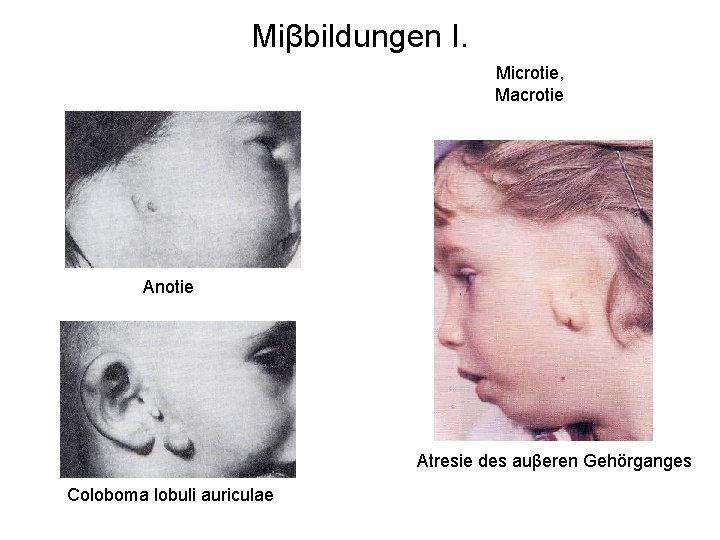 Miβbildungen I. Microtie, Macrotie Anotie Atresie des auβeren Gehörganges Coloboma lobuli auriculae 