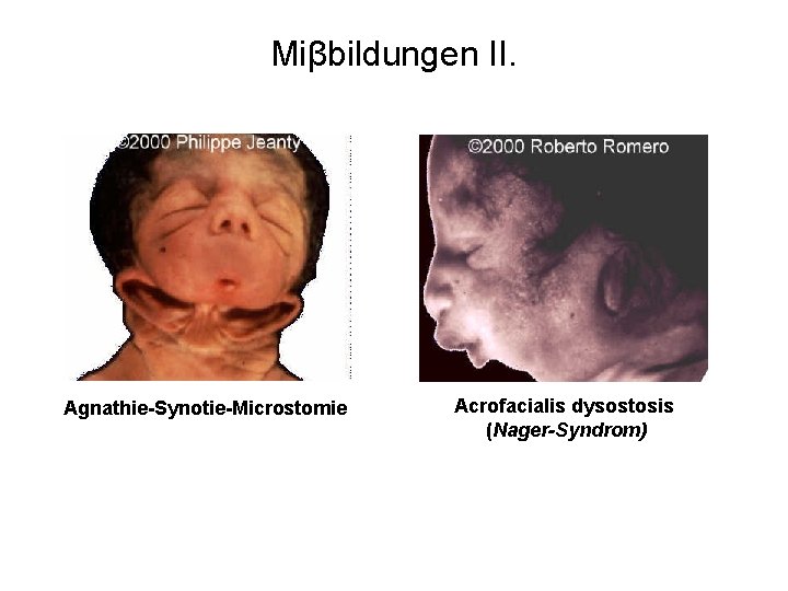 Miβbildungen II. Agnathie-Synotie-Microstomie Acrofacialis dysostosis (Nager-Syndrom) 