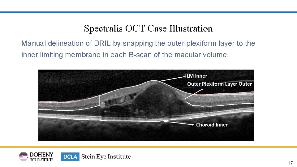 Spectralis OCT Case Illustration Manual delineation of DRIL by snapping the outer plexiform layer