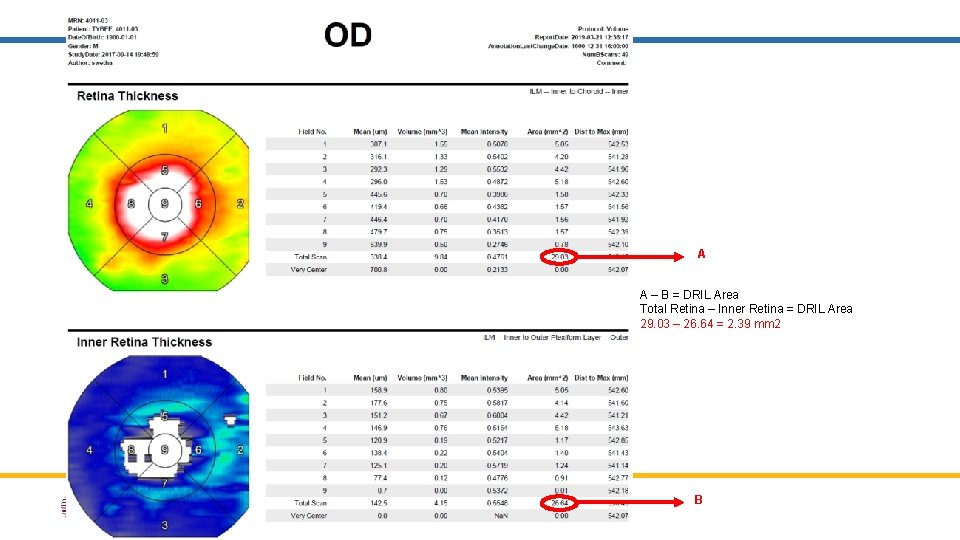 A A – B = DRIL Area Total Retina – Inner Retina = DRIL