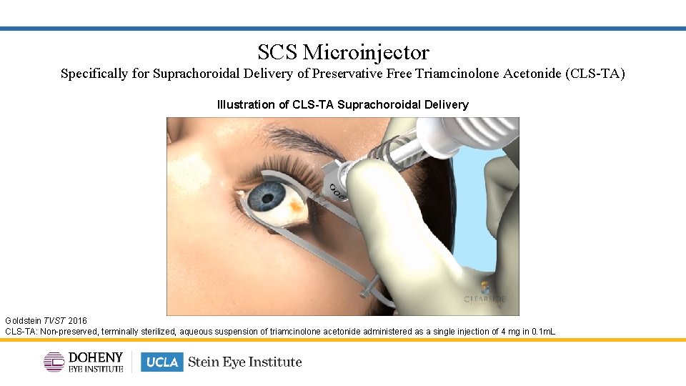 SCS Microinjector Specifically for Suprachoroidal Delivery of Preservative Free Triamcinolone Acetonide (CLS-TA) Illustration of