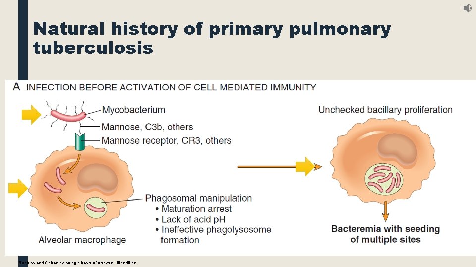 Natural history of primary pulmonary tuberculosis Robbins and Cotran pathologic basis of disease, 10
