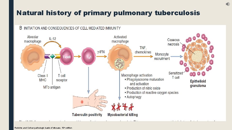Natural history of primary pulmonary tuberculosis Granulomatous inflammation and tissue damage. Inaddition to stimulating