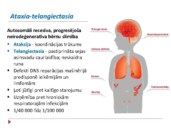 Ataxia-telangiectasia Autosomāli recesīva, progresējoša neirodeģeneratīva bērnu slimība § Ataksija - koordinācijas trūkums § Telangiectasia
