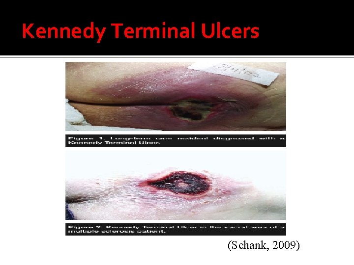 Kennedy Terminal Ulcers (Schank, 2009) 