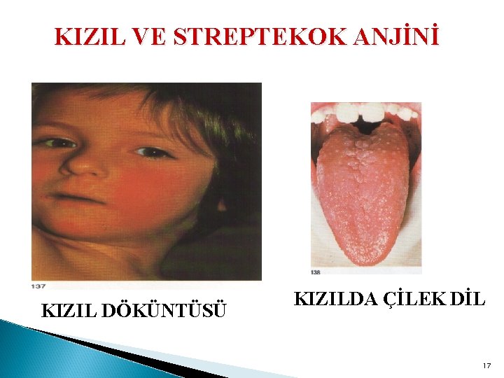 KIZIL VE STREPTEKOK ANJİNİ KIZIL DÖKÜNTÜSÜ KIZILDA ÇİLEK DİL 17 