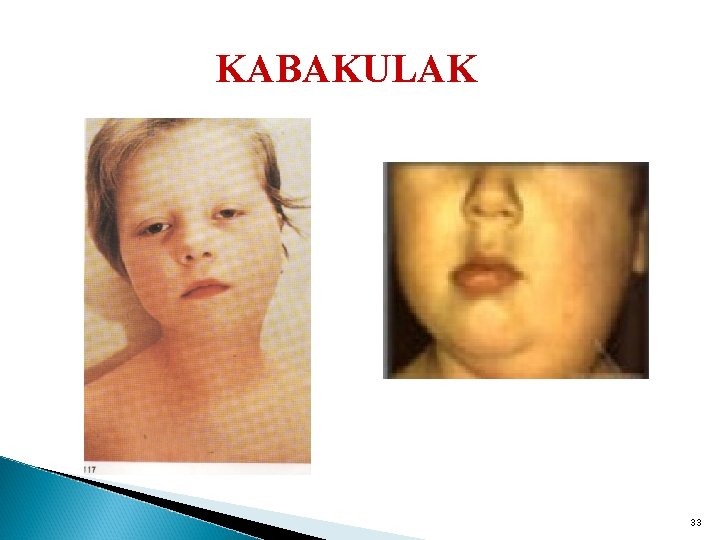KABAKULAK 33 