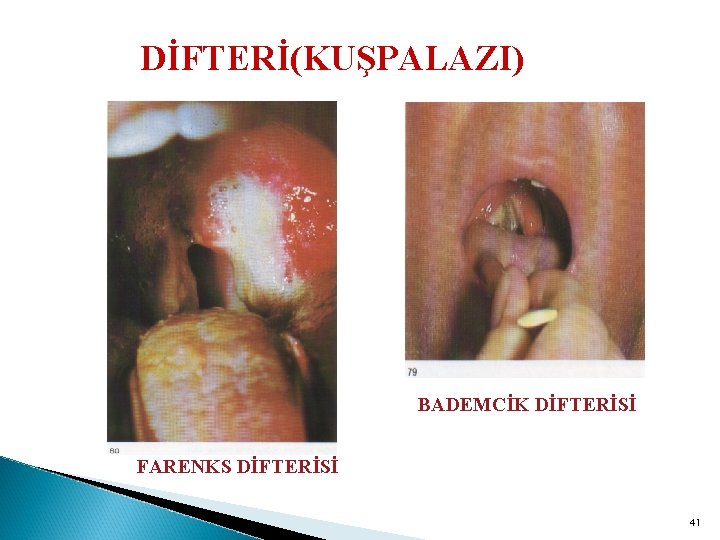 DİFTERİ(KUŞPALAZI) BADEMCİK DİFTERİSİ FARENKS DİFTERİSİ 41 