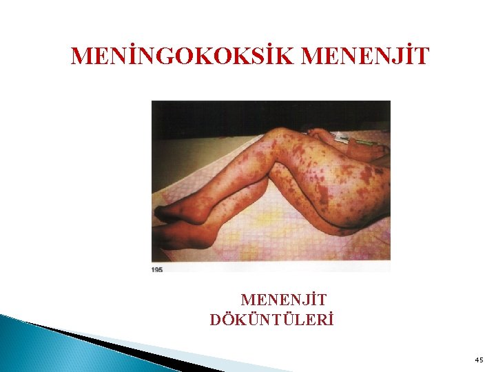 MENİNGOKOKSİK MENENJİT DÖKÜNTÜLERİ 45 
