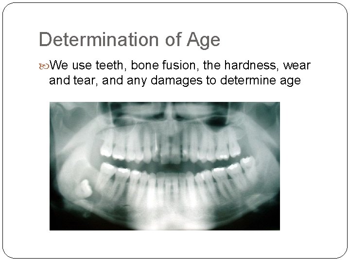 Determination of Age We use teeth, bone fusion, the hardness, wear and tear, and Determination of Age We use teeth, bone fusion, the hardness, wear and tear, and