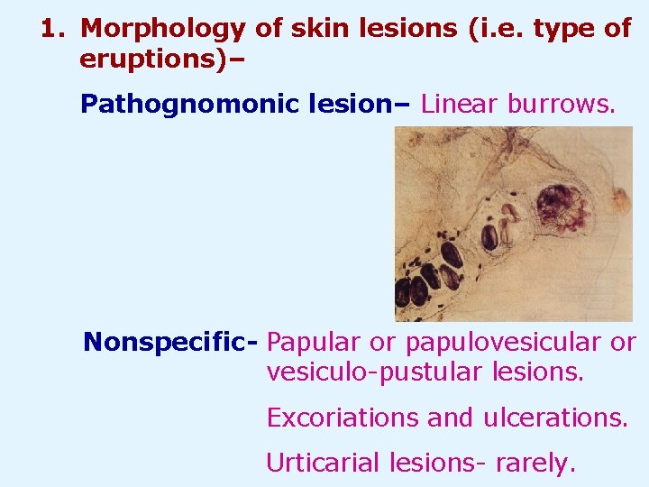 1. Morphology of skin lesions (i. e. type of eruptions)– Pathognomonic lesion– Linear burrows.
