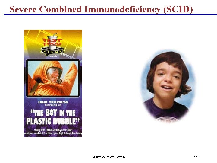 Severe Combined Immunodeficiency (SCID) Chapter 21, Immune System 114 
