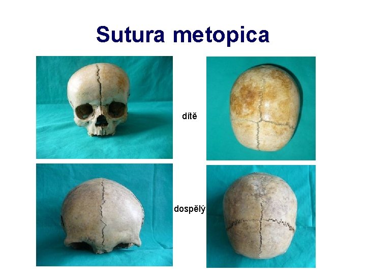 Sutura metopica dítě dospělý 