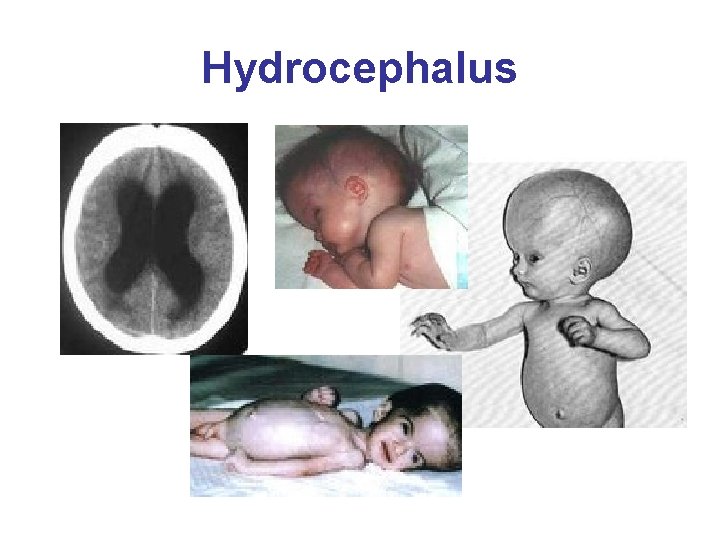 Hydrocephalus 
