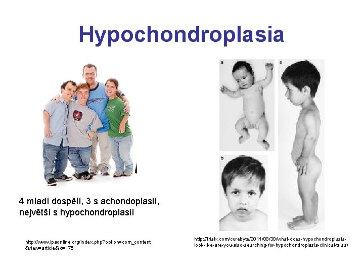 Hypochondroplasia 4 mladí dospělí, 3 s achondoplasií, největší s hypochondroplasií http: //www. lpaonline. org/index.