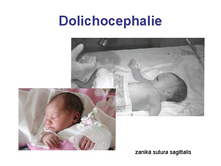 Dolichocephalie zaniká sutura sagittalis 