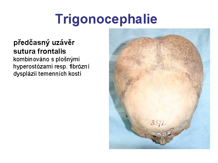 Trigonocephalie předčasný uzávěr sutura frontalis kombinováno s plošnými hyperostózami resp. fibrózní dysplázií temenních kostí