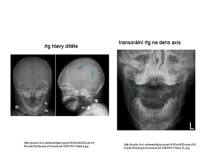 rtg hlavy dítěte http: //public. fnol. cz/www/rtg/program%20 na%20 vyuku% 20 radiol%20 popisu/Vysledne/CD 4/SIPKY/lebka. jpg