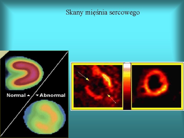 Skany mięśnia sercowego 