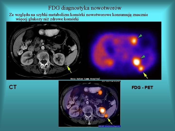 FDG diagnostyka nowotworów Ze względu na szybki metabolizm komórki nowotworowe konsumują znacznie więcej glukozy