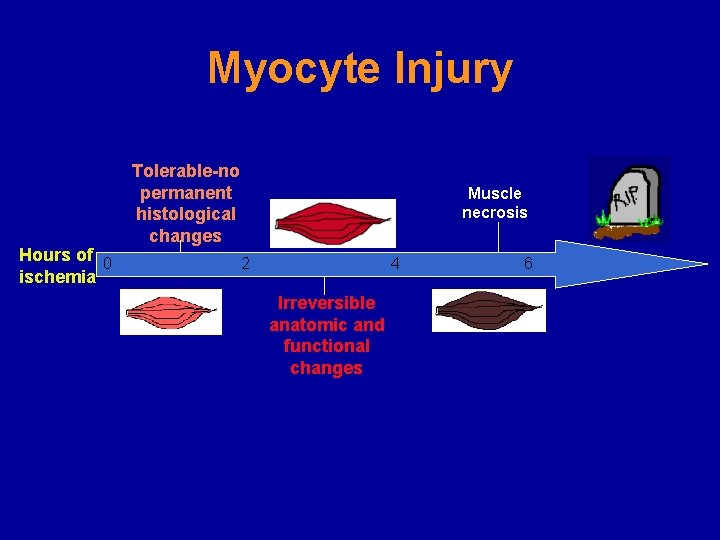 Crush Injuries and Rhabdomyolysis Dr M Mortazavi Nephrologist