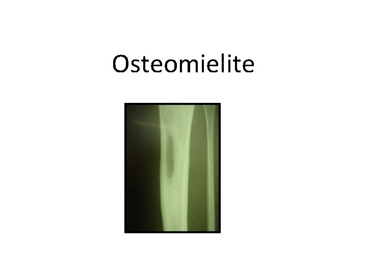 Osteomielite 