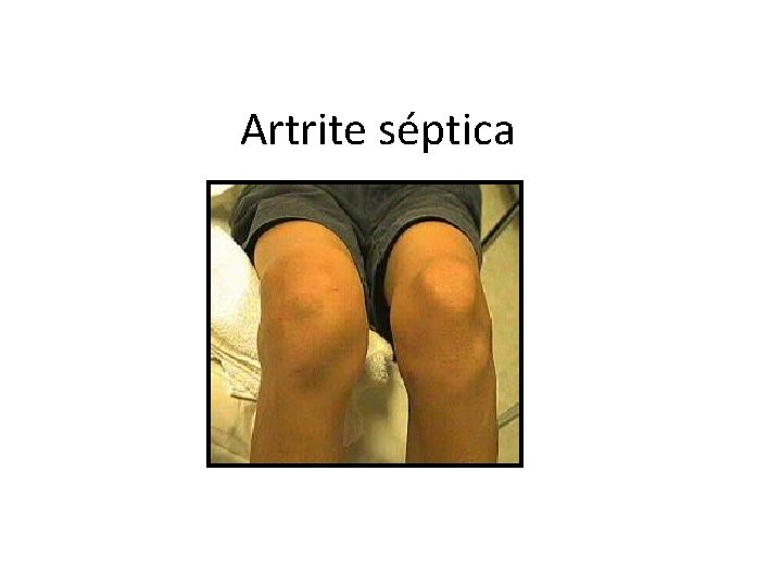 Artrite séptica 