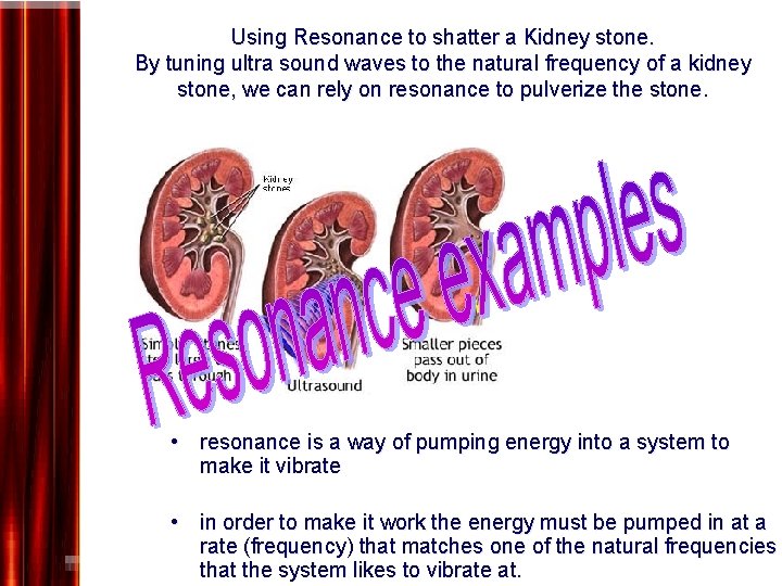 Using Resonance to shatter a Kidney stone. By tuning ultra sound waves to the