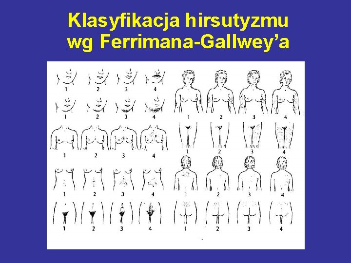 Klasyfikacja hirsutyzmu wg Ferrimana-Gallwey’a 