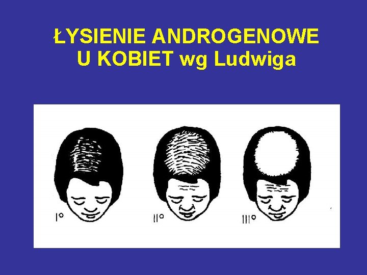 ŁYSIENIE ANDROGENOWE U KOBIET wg Ludwiga 