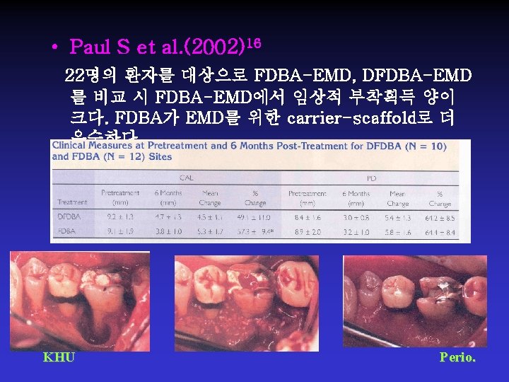  • Paul S et al. (2002)16 22명의 환자를 대상으로 FDBA-EMD, DFDBA-EMD 를 비교