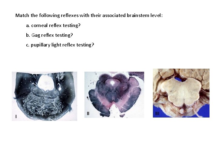 Match the following reflexes with their associated brainstem level: a. corneal reflex testing? b. Match the following reflexes with their associated brainstem level: a. corneal reflex testing? b.