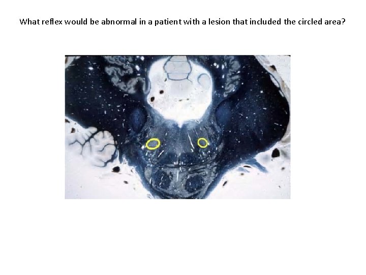 What reflex would be abnormal in a patient with a lesion that included the